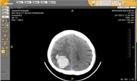 Brain CT Scan
